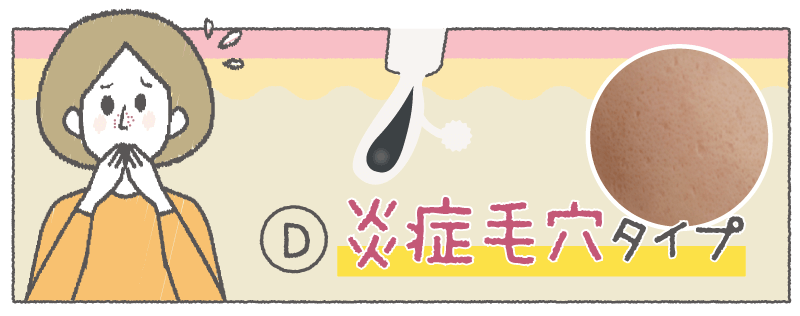 Ⓓ 炎症毛穴タイプ