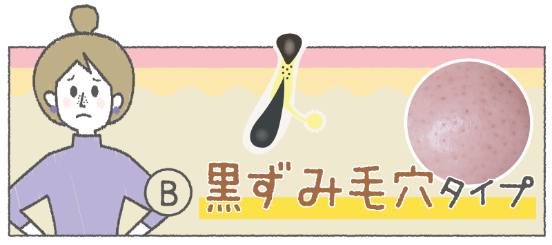 Ⓑ 黒ずみ毛穴タイプ