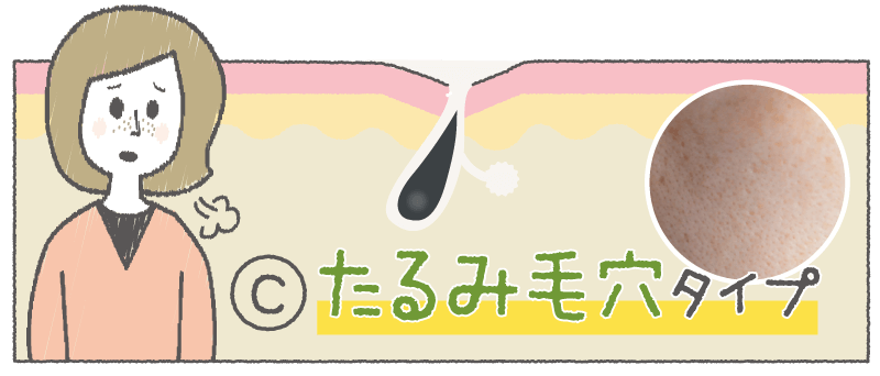 Ⓒ たるみ毛穴タイプ